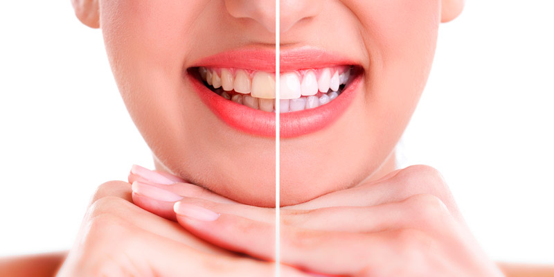 especialidad blanqueamiento dental