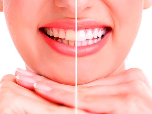 Amplus Odontologia Blanqueamientos Santiago