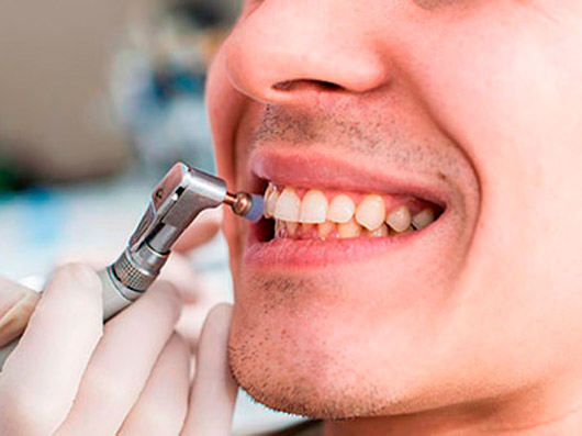 Amplus Odontologia Limpieza dental