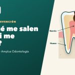 Corte de una muela con caries que avanza del esmalte a la dentina hacia el nervio